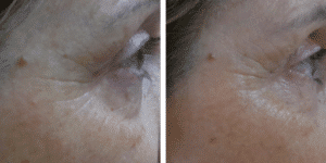 resultado tratamiento facial skin personalizado