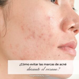 Cómo evitar las marcas de acné