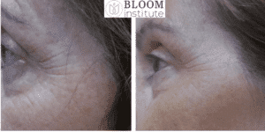 antes y después tratamiento facial personalizado