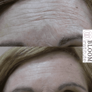 tratamiento facial personalizado antes y después