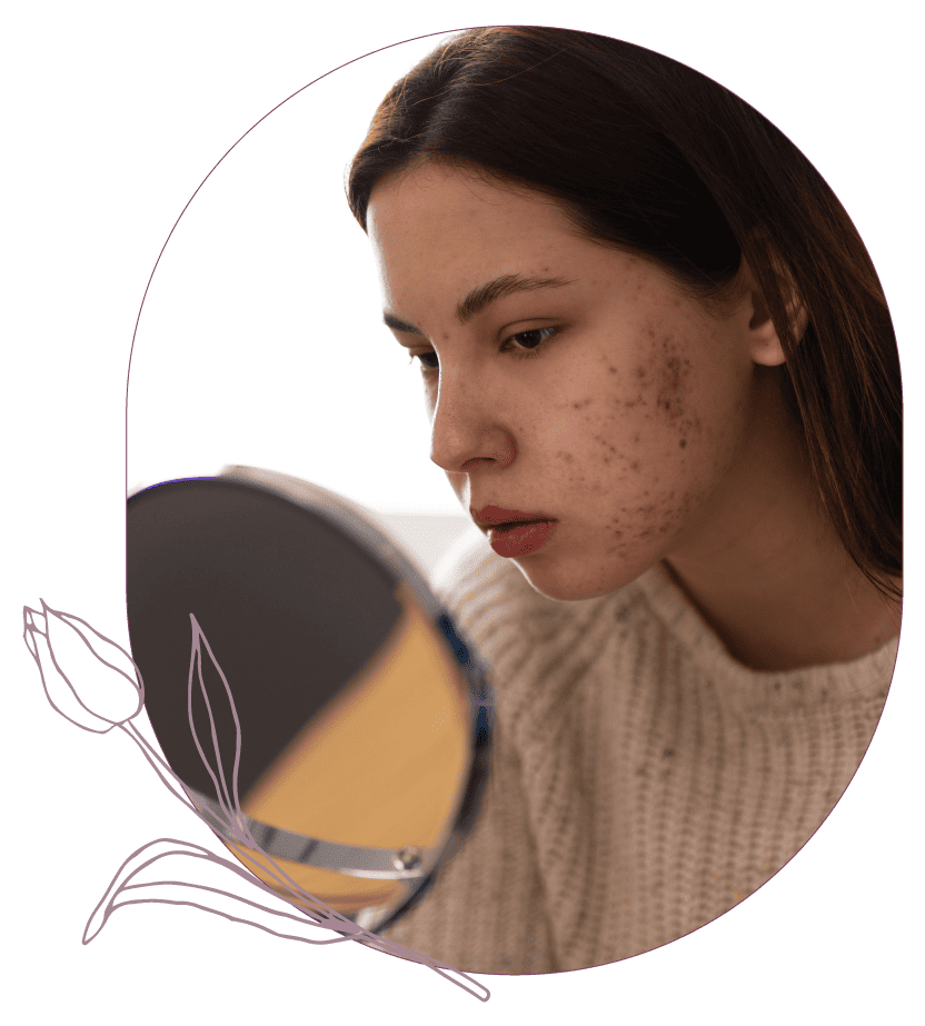 eliminación de cicatrices de acne