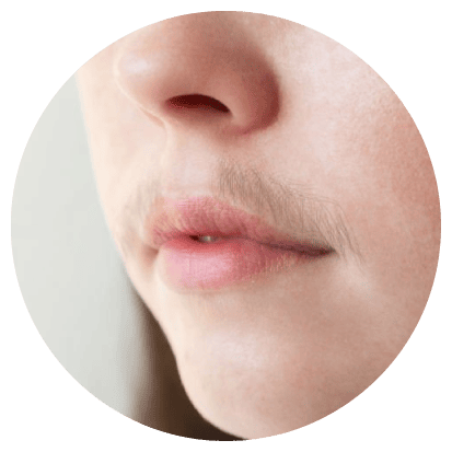 exceso de vello bigote mujer