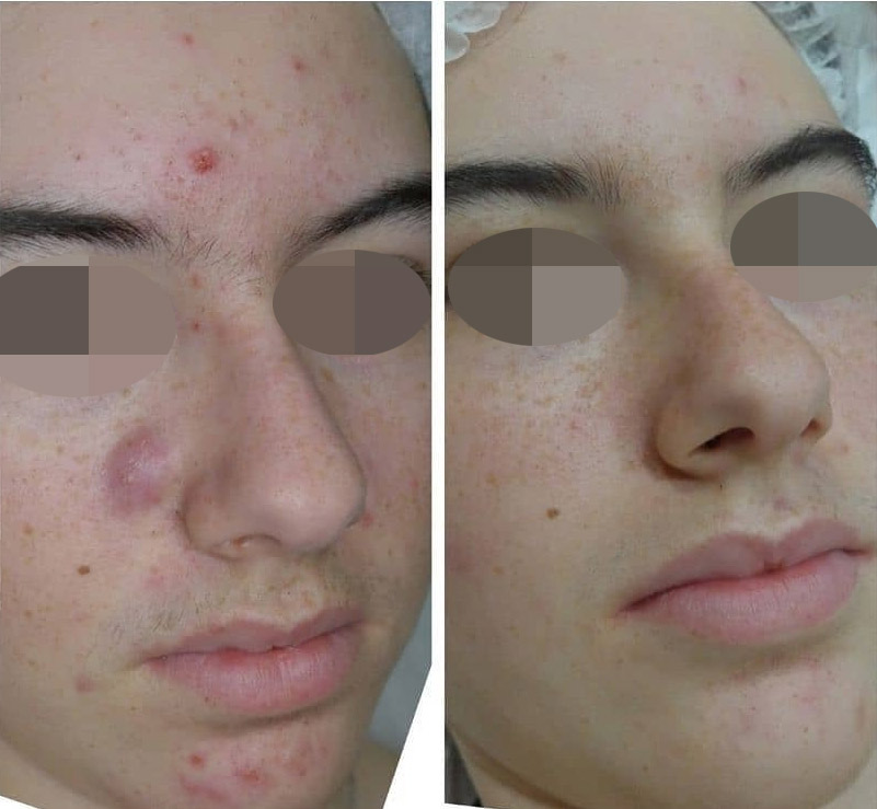 Antes y después Tratamiento anti acne