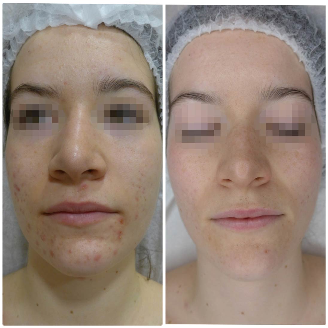 Antes y después Tratamiento anti acne