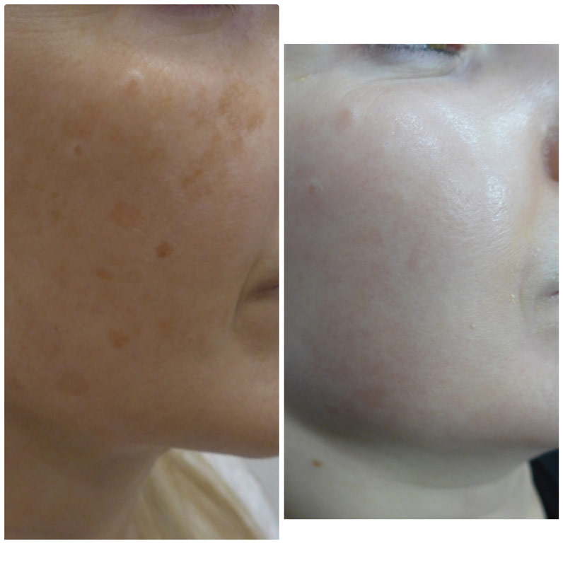 antes y después manchas en la piel