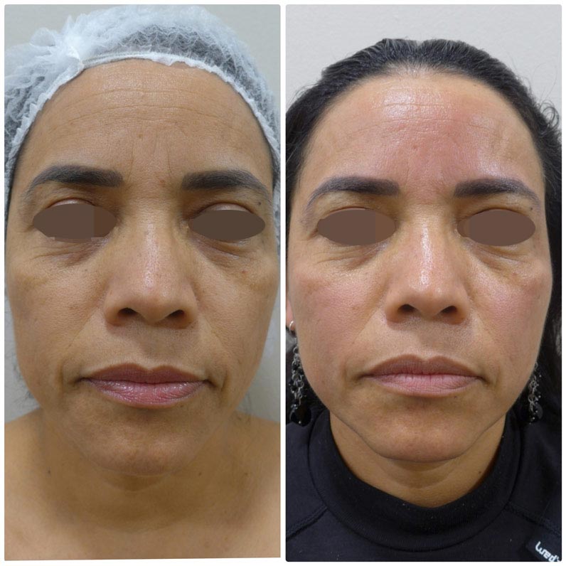 antes y después radiofrecuencia facial
