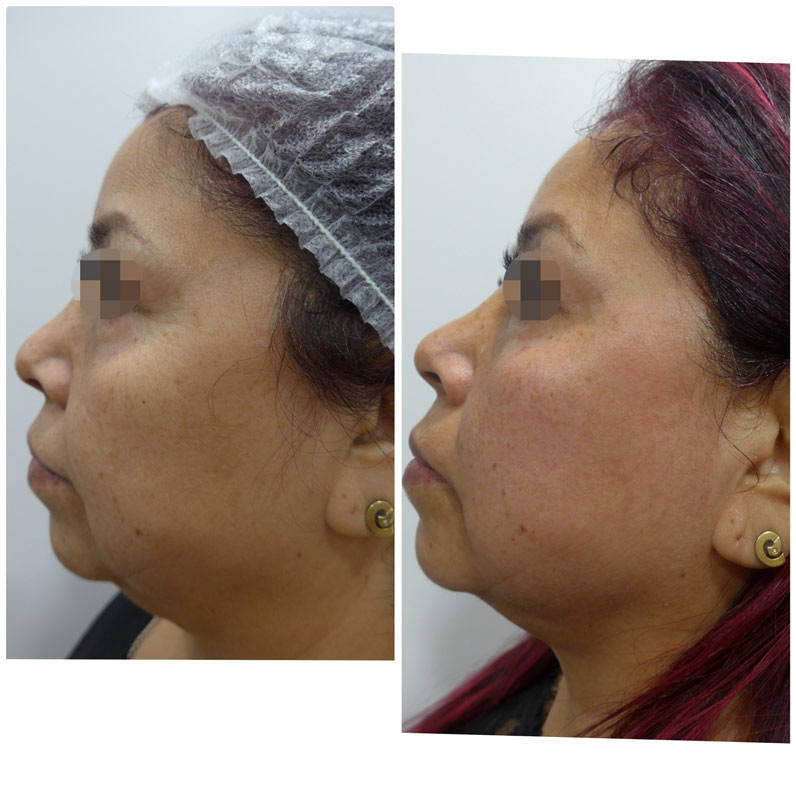 antes y despues hifu facial