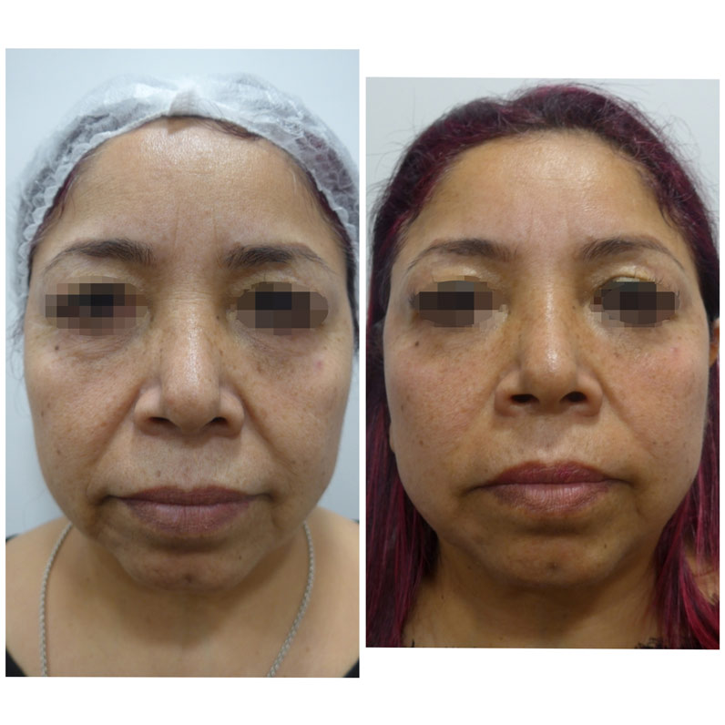 antes y despues hifu facial