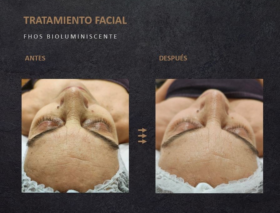 fhos-antes-y-despues-facial