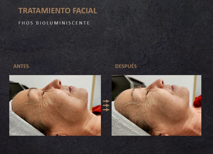 fhos-facial-antes-y-despues