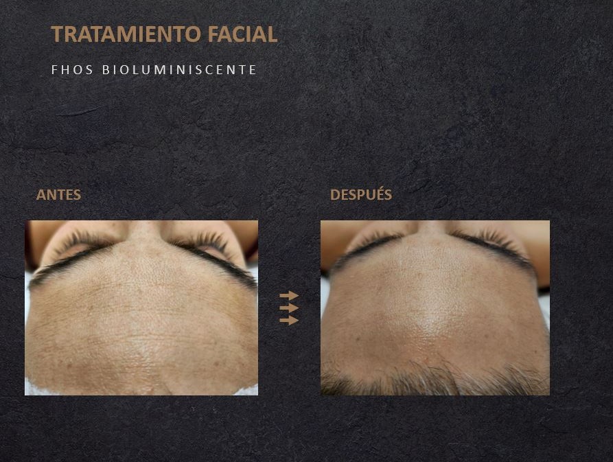 tratamientos-fhos-antes-y-despues